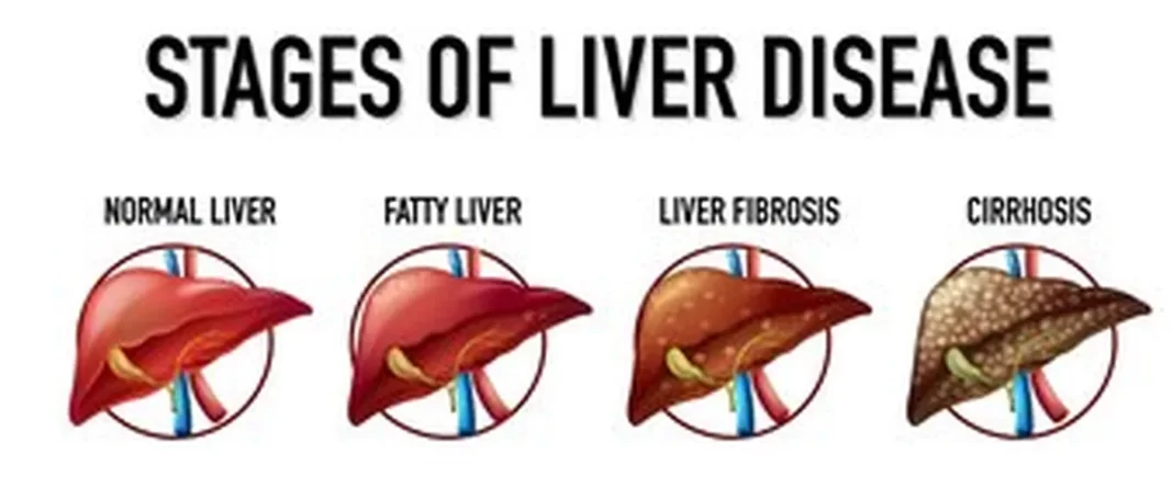 A sudden increase in acne is a Potential Sign of Liver Cirrhosis!