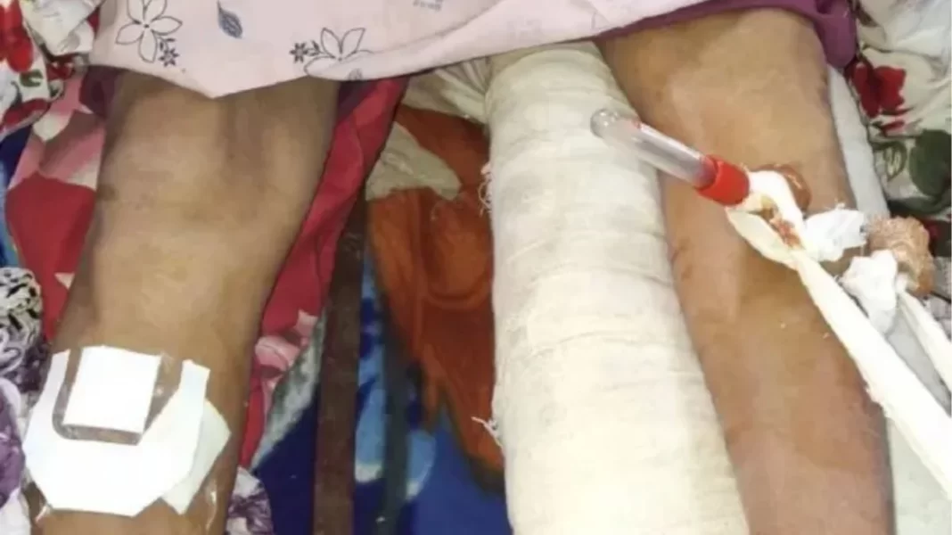 Severe Medical Negligence at Indian Hospital: Left Leg Fracture, Surgery Performed on Right Leg